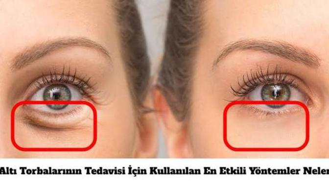 Göz altı torbaları nasıl geçer?