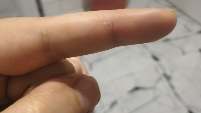 Parmakta bir siyah nokta var içinde gibi? cildiye?