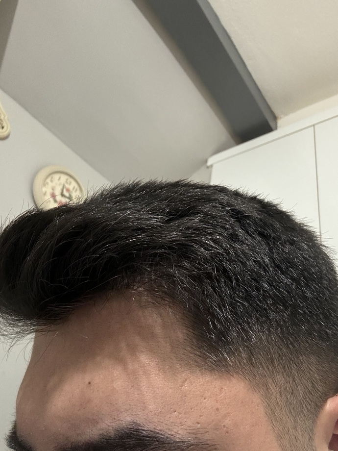 Sizce saçlarım seyrek mi kellik problemi yaşar mıyım?