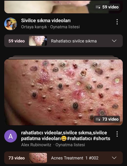 Kardeşim sürekli akne sıkma, ASMR videoları izliyor ve bundan zevk alıyor. Bu normal mi?