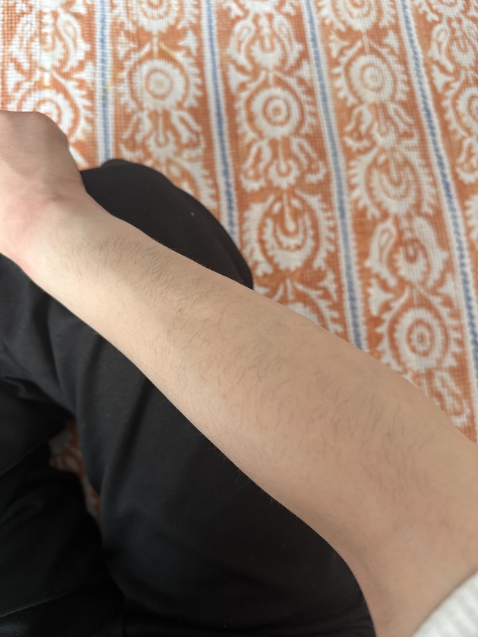 Lazerci geçen seans kılların bitmiş deyip tarama yapıp gönderdi?