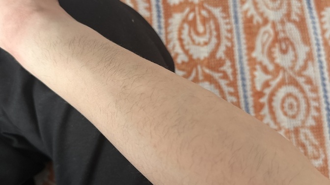 Lazerci geçen seans kılların bitmiş deyip tarama yapıp gönderdi?