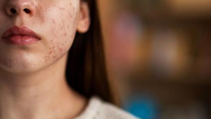 Sivilcelerin kendi kendine iyileşmesini beklemek doğru mu?