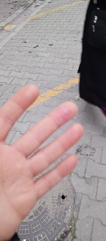 Parmaklarim su topladi bir hafta oldu iyilesmedi krem surdum ama nasil gecer?