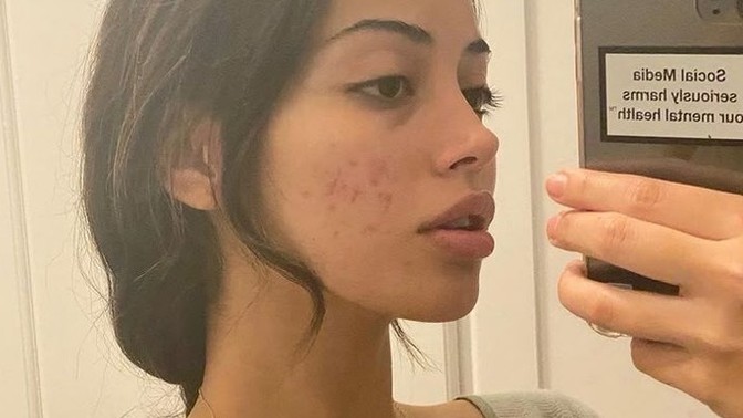 Yeşil çay sivilceleri geçirmede gerçekten etkili mi?