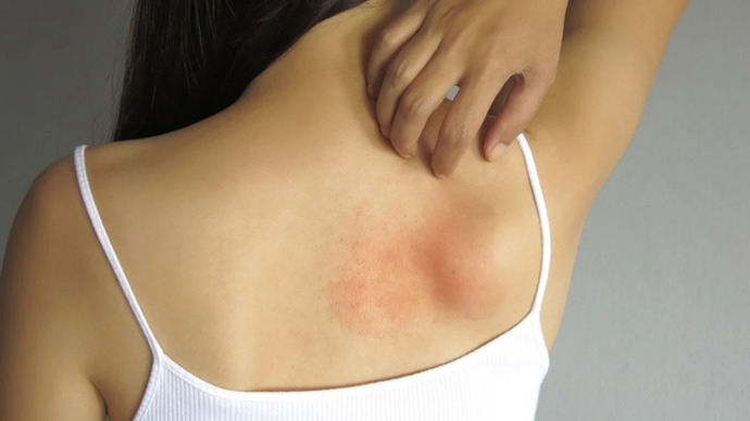 Sırtımda sivilce problemi yaşıyorum, bu sorunu giderebilecek bir ürün öneriniz var mı?