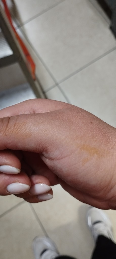Elimdeki sarı turuncu leke ne olabilir?