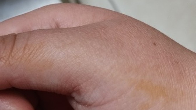 Elimdeki sarı turuncu leke ne olabilir?