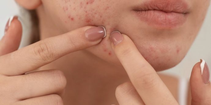 Cilt tipin sivilceye yatkın mı?