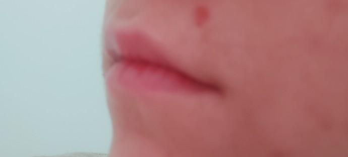 Dudağımın üstünde sivilce çıktı. Hangi ürünü kullanmalıyım?