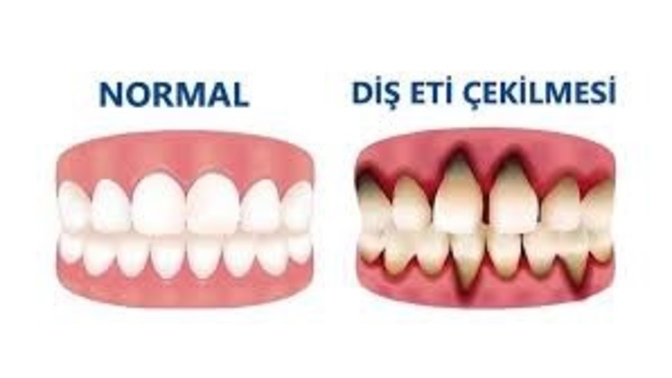 Diş eti çekilmesi yaşayanlar?