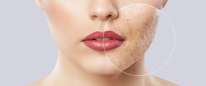 Sivilce karşıtı bakımda çay ağacı yağı mı, niacinamide mi?