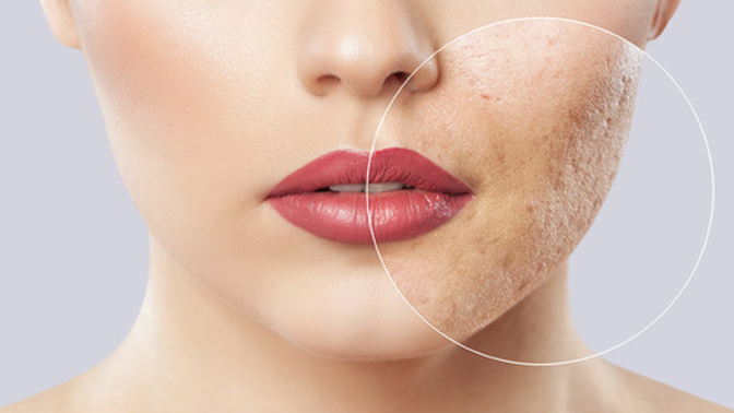 Sivilce karşıtı bakımda çay ağacı yağı mı, niacinamide mi?