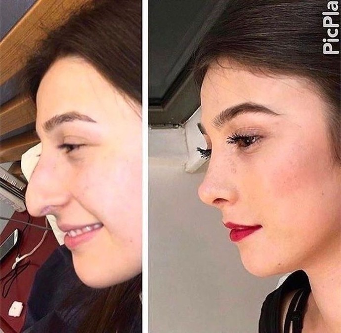 Her kızın küçük burunu olmak zorunda mı?