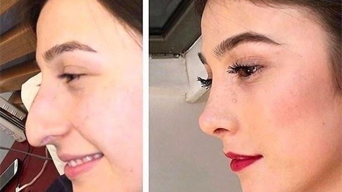 Her kızın küçük burunu olmak zorunda mı?
