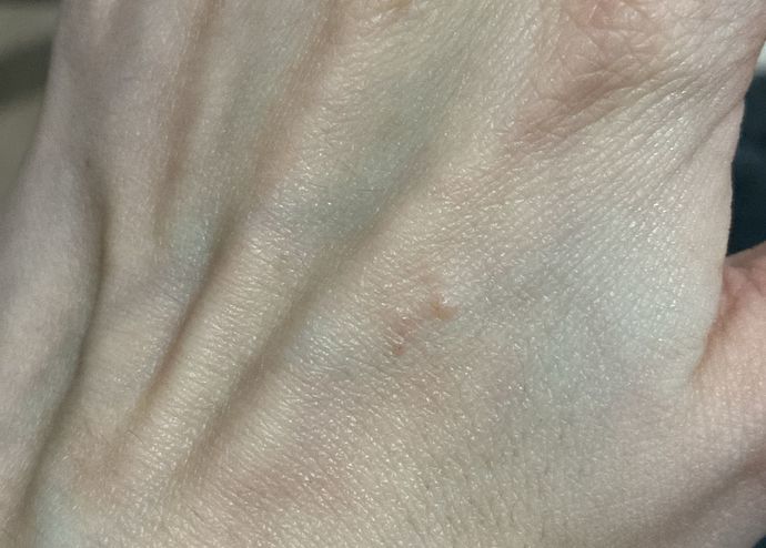Elim kaşınıyodu şöyle kabardı ne bu bir şey mi ısırmış?