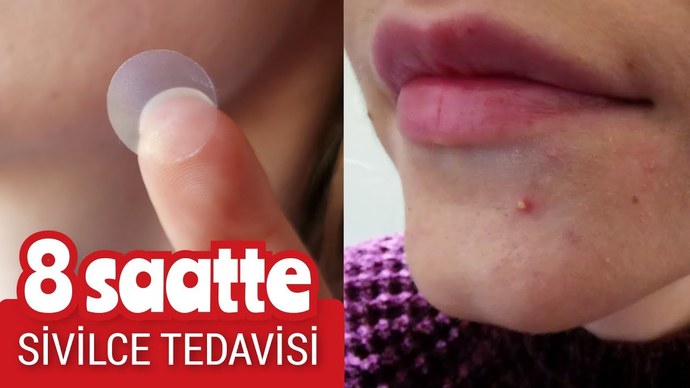 Sivilce bantları gerçekten mucize mi, yoksa büyük beklenti mi?