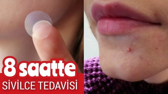 Sivilce bantları gerçekten mucize mi, yoksa büyük beklenti mi?