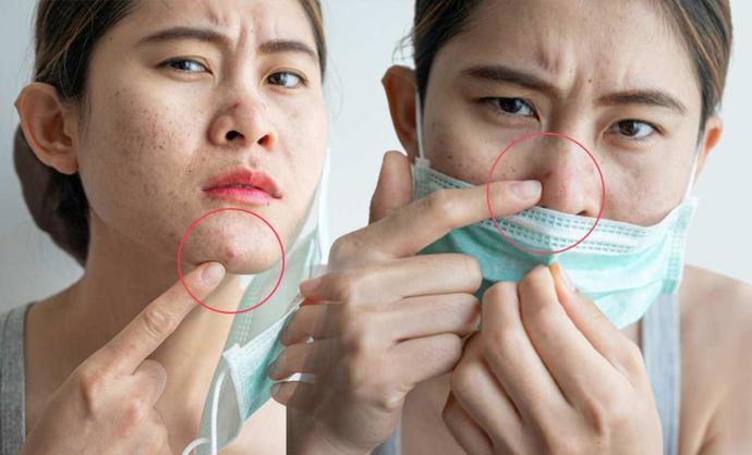 Maske takmak sivilce yapıyor mu? Sen maske takarken nasıl bir önlem alıyorsun?