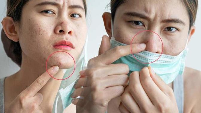 Maske takmak sivilce yapıyor mu? Sen maske takarken nasıl bir önlem alıyorsun?