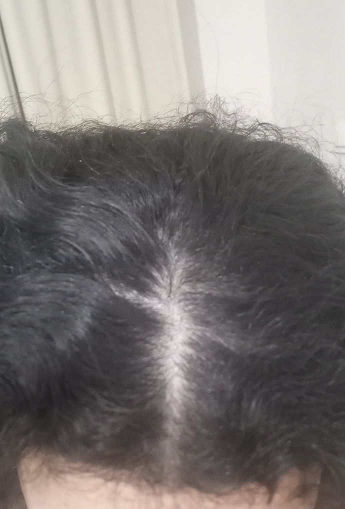 Arjadaşlar benim saçım dökülüyor özellikle sol kısmı? çok mu dökülmüş sizce? neden olabilir bide bu? Saçım kirli biraz onu görmezd?