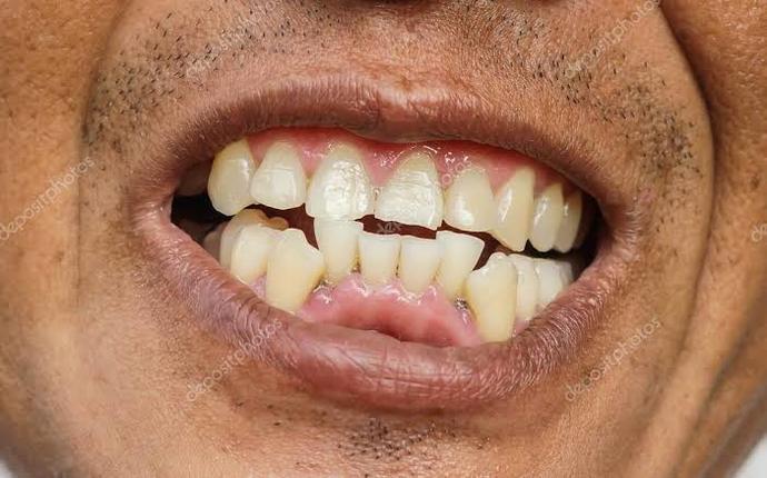Erkeklere soruyorum. adamın arabası var. Parası var yani bu adam dişlerini neden yaptırmıyor. Genç olmasına rağmen?