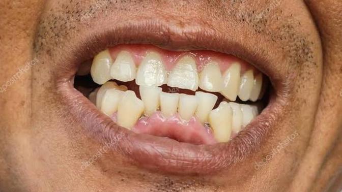 Erkeklere soruyorum. adamın arabası var. Parası var yani bu adam dişlerini neden yaptırmıyor. Genç olmasına rağmen?