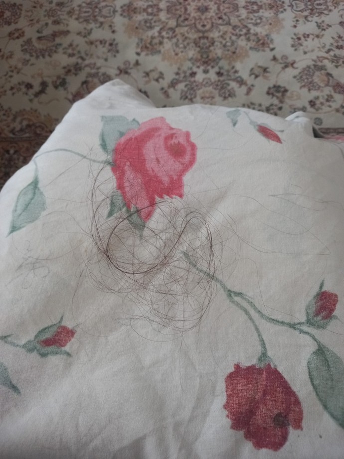 Saçların bu kadar dökülmesi normal mi?