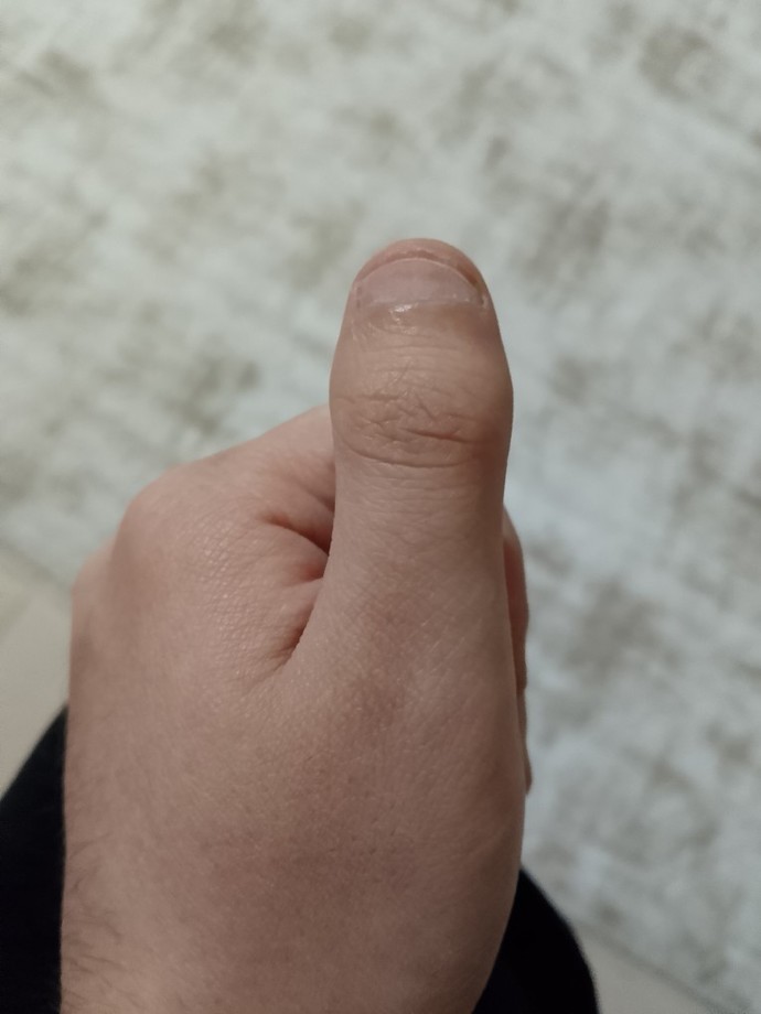 Baş parmağı böyle olan var mı?
