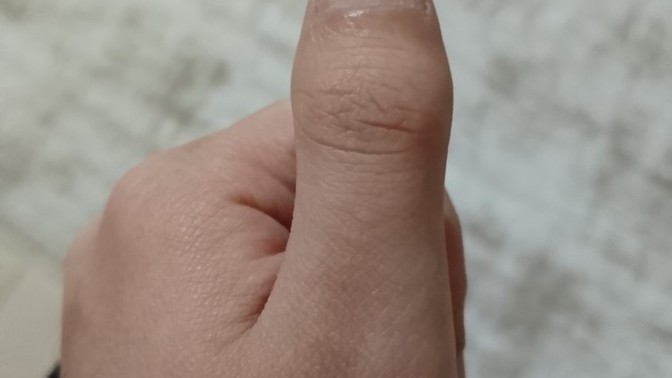 Baş parmağı böyle olan var mı?