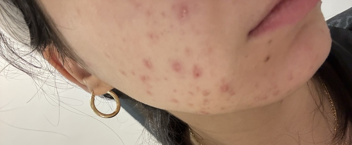 Akne ve sivilce durumum?