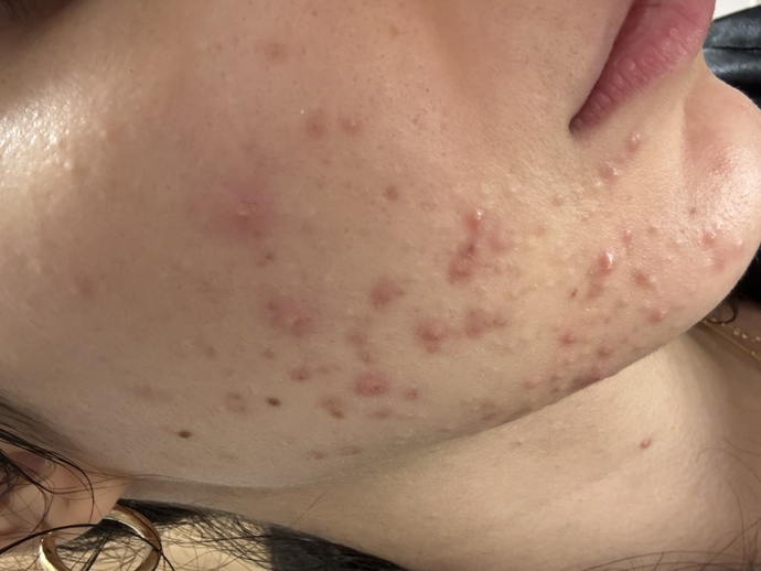 Akne ve sivilce durumum?