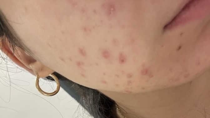 Akne ve sivilce durumum?