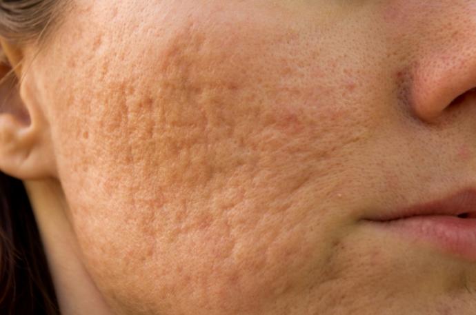 Roaccutane ciltteki lekeleri de geçiriyor mu?