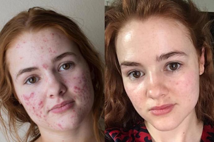 Roaccutane ciltteki lekeleri de geçiriyor mu?