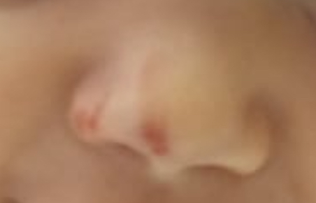 8 aylık bebek koltuktan düştü burnu böyle oldu bişe olur mıu?