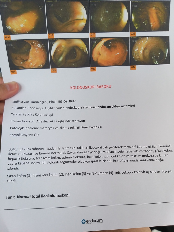 Endoskopi ve kolonoskopi sonucunu bırakıyorum anlayanlar bakabilir mi?