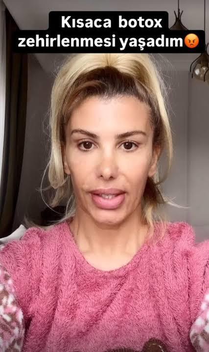 Hiç botoks zehirlenmesi yaşadınız mı?