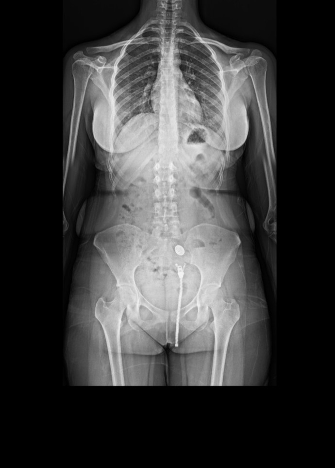 Röntgen fotoğrafı niye bu kadar tuhaf?