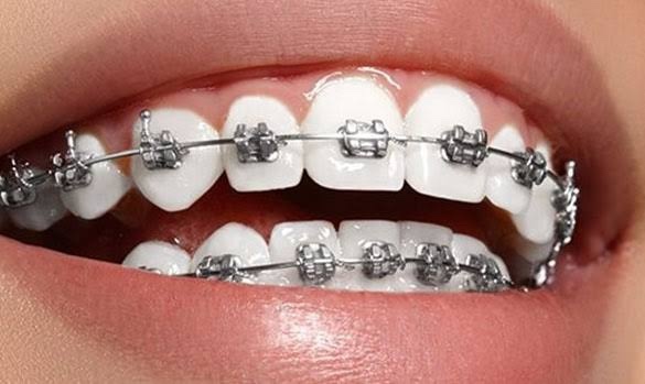 Diş teli ortalama ne kadardır?