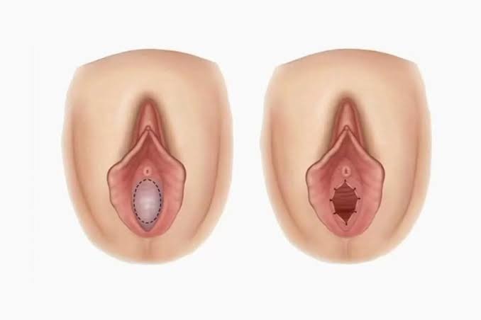 Kızlık zarı dikimi neden toplum tarafından ağır bir şekilde eleştiriliyor?