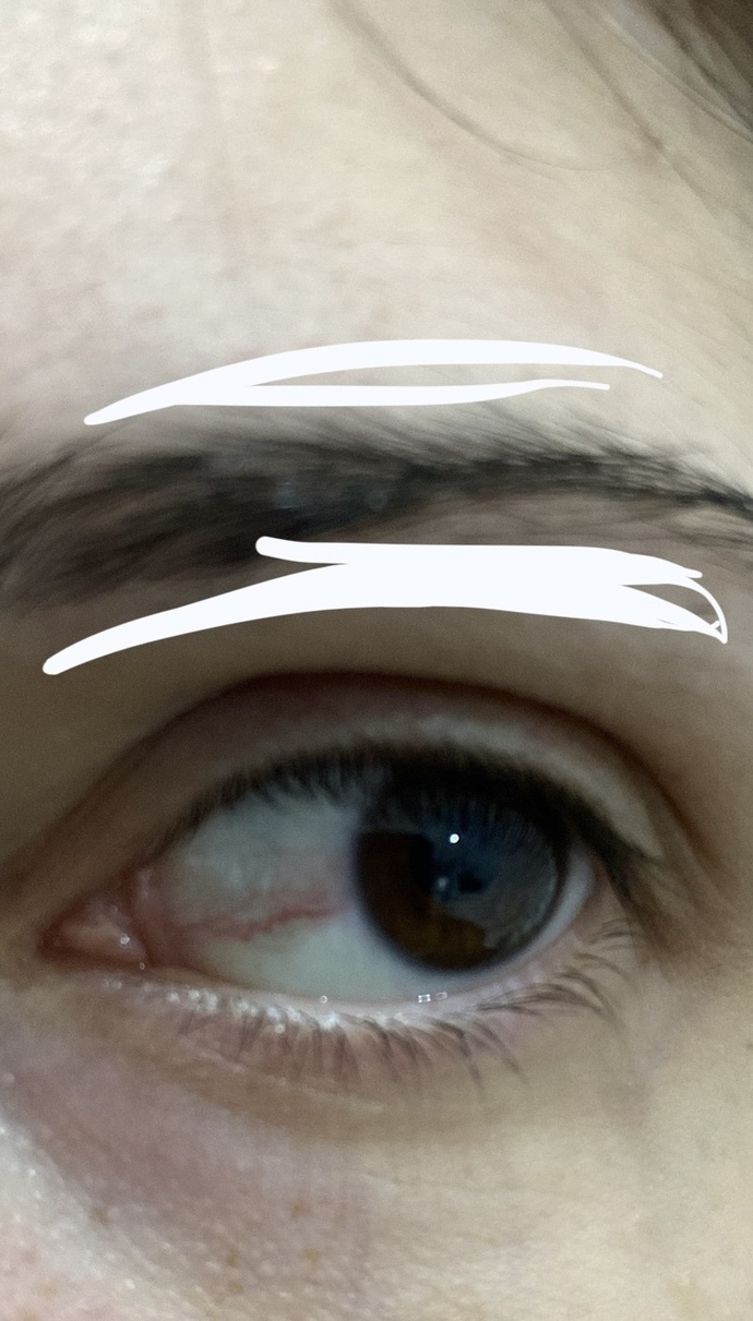 Gözümde böyle bir şey oluştu, normal bir şey mi?
