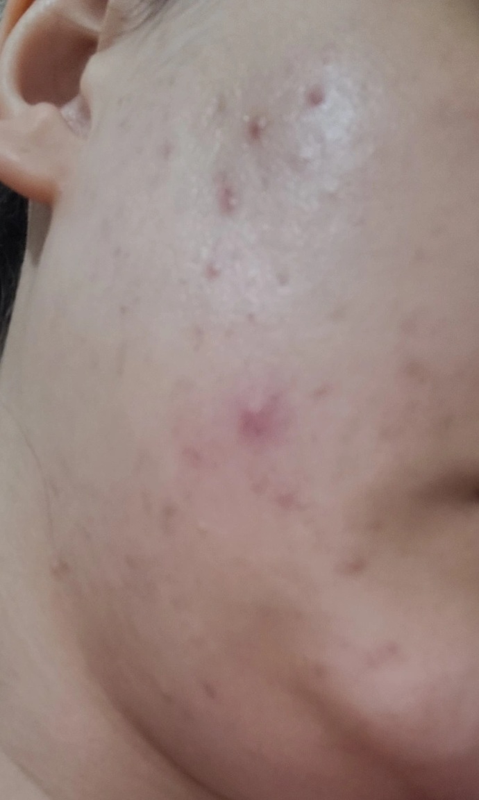 Yüzümdeki akne ve lekeleri nasıl geçirebilirim?