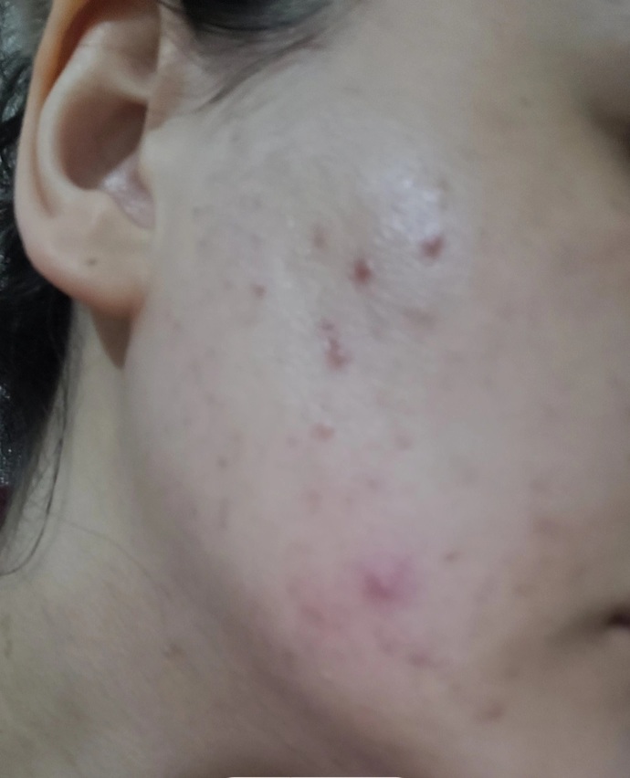 Yüzümdeki akne ve lekeleri nasıl geçirebilirim?