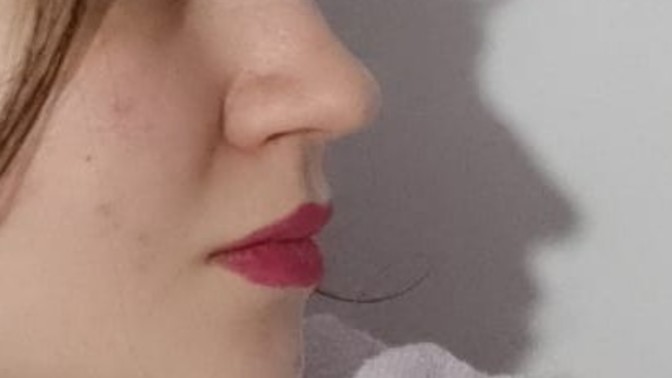 Sizce burnuma estetik yaptırayım mı?