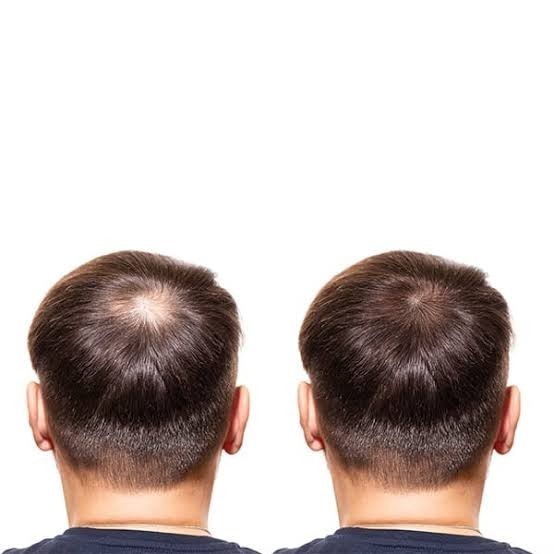 Bira içmek saç dökülmesi yapar mı yoksa öyle algımı yapılıyor?