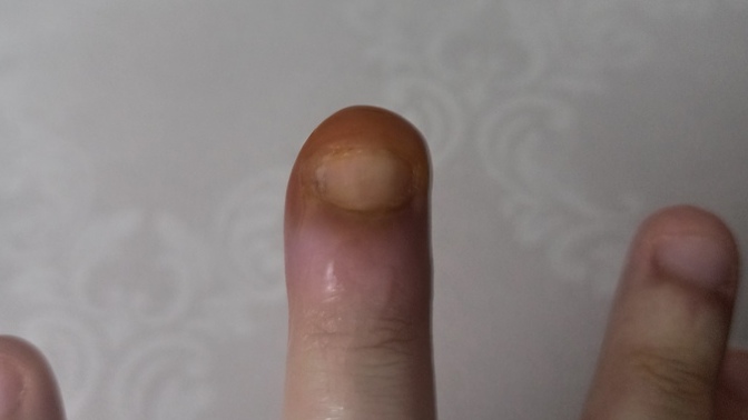 Dolama olan parmak nasıl geçer?