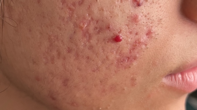 Kardeşimin yüzündeki akne?
