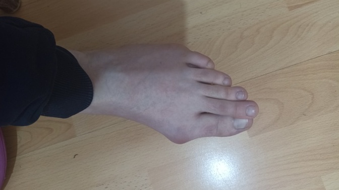 Ayağım ameliyat ile düzelir mi?