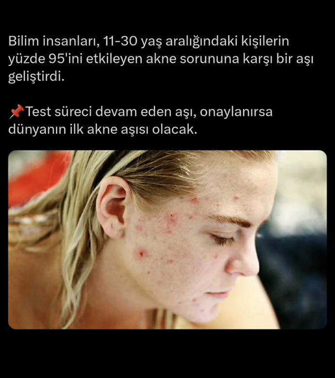 Sivilce aşısı olur musunuz?